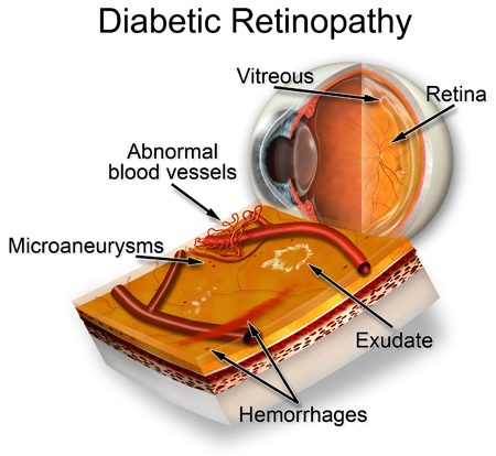 diabetes Treating Type II Diabetes Goes Past  Medicines  And Diet.