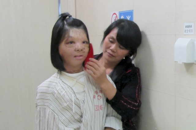 Xu Jianmei, a 17-year-old girl, looks at a mirror as her mother combs her hair after a reconstruction surgery of her face at a hospital in Fuzhou