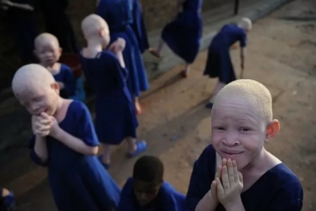 african-albinos