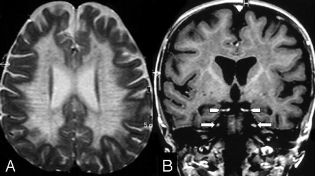 rarediseases2