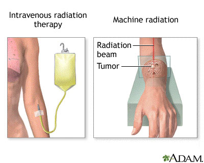 pain-radiation