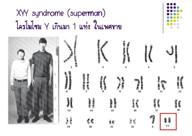 xyy-syndrome